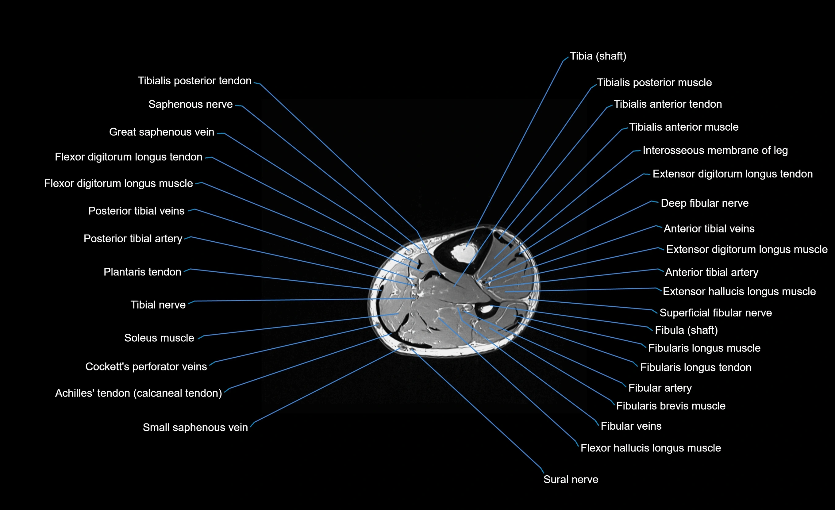 MRI lower leg axial cross sectional anatomy 3T  radiology  image-img-00001-00071.webp
